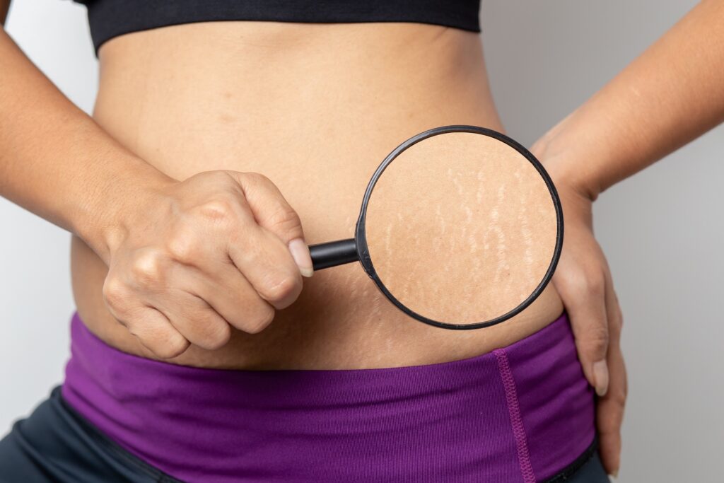 Stretch Marks | Radiance Medical Spa in Coralville IA