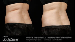 Before And After treatment effect | Radiance Medical Spa in Coralville IA