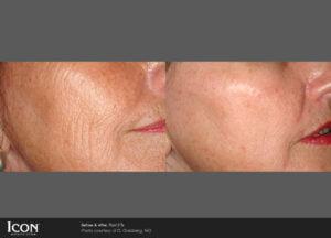 Cheek Before And After Image | Radiance Medical Spa in Coralville IA