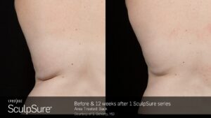 Before And After | Radiance Medical Spa in Coralville IA