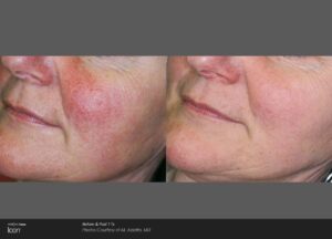 Before And After Image | Radiance Medical Spa in Coralville IA