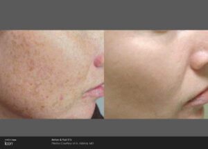 Cheek Before And After Image | Radiance Medical Spa in Coralville IA