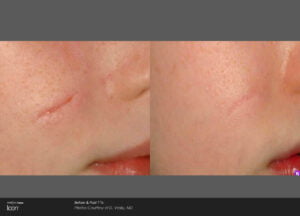 Before And After Image | Radiance Medical Spa in Coralville IA