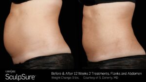 Before And After treatment effect | Radiance Medical Spa in Coralville IA