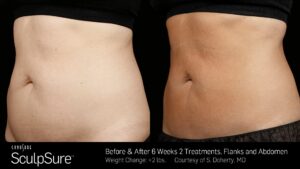 Before And After treatment effect | Radiance Medical Spa in Coralville IA