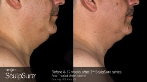 Before And After Sculpsure | Radiance Medical Spa in Coralville IA