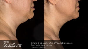 Before And After | Radiance Medical Spa in Coralville IA