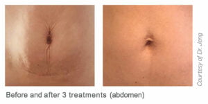 Before and After Images | Tempsure at Radiance Medical Spa in Coralville IA