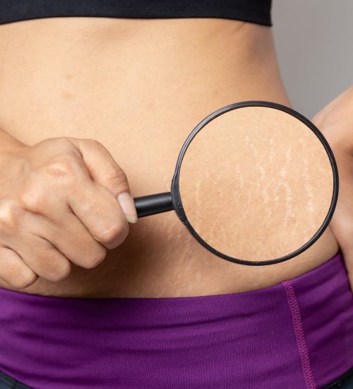 Stretch Marks | Radiance Medical Spa in Coralville IA