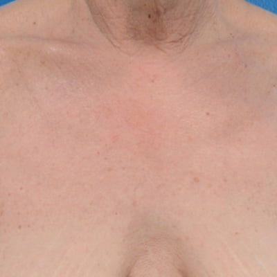 BBL Treatment After | Radiance Medical Spa in Coralville IA