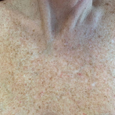 BBL Treatment Before | Radiance Medical Spa in Coralville IA BBL Treatment Before | Radiance Medical Spa in Coralville IA