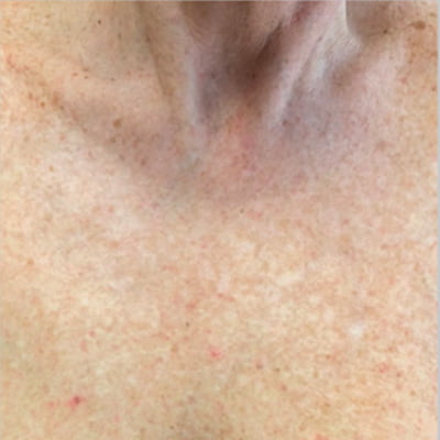 BBL Treatment before | Radiance Medical Spa in Coralville IA BBL Treatment before | Radiance Medical Spa in Coralville IA