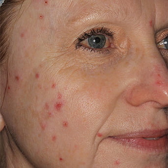 Forever Clear BBL girl face before | Radiance Medical Spa in Coralville IA Forever Clear BBL girl face before | Radiance Medical Spa in Coralville IA