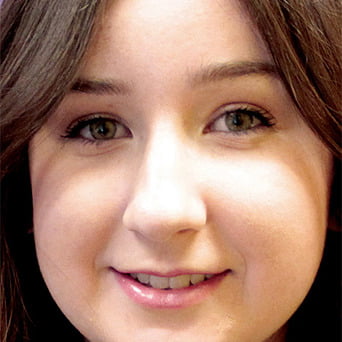 Forever Clear BBL girl face after | Radiance Medical Spa in Coralville IA