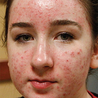 Forever Clear BBL girl face before | Radiance Medical Spa in Coralville IA Forever Clear BBL girl face before | Radiance Medical Spa in Coralville IA