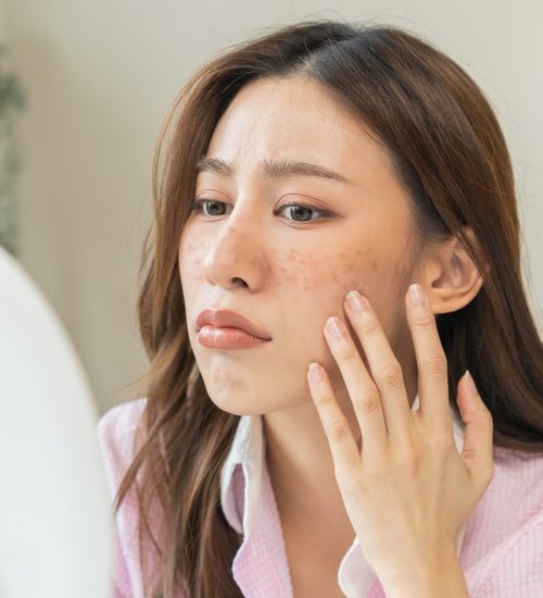 Age Spots | Radiance Medical Spa in Coralville IA